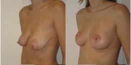 Lifting seins tunisie