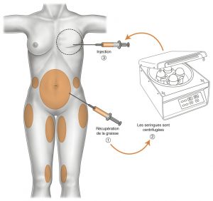 lipofilling mammaire tunisie