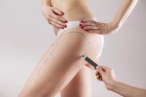 prix liposuccion cuisses tunisie