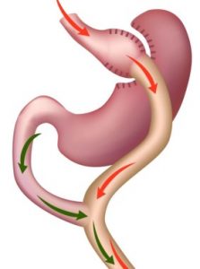 bypass-gastrique