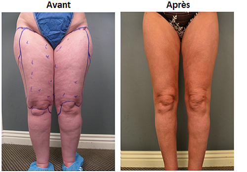 liposuccion cuisse avant apres