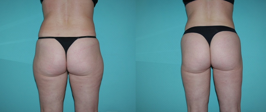 liposuccion cuisses tunisie