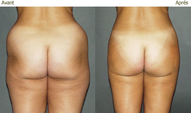 liposuccion culotte cheval Tunisie