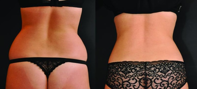 liposuccion poignees d amour tunisie