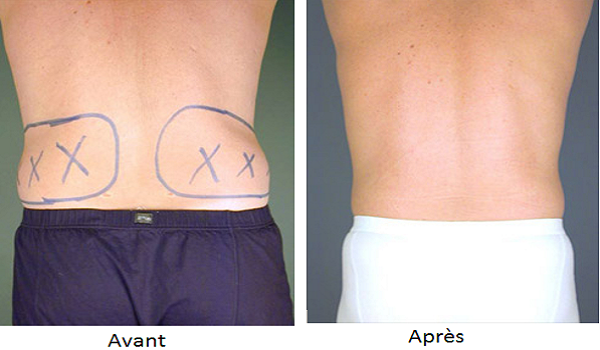 liposuccion poignees damour photos avant apres