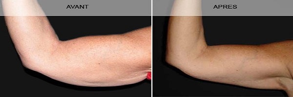 photos liposuccion bras