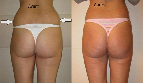 photos liposuccion poignees d amour