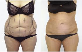 lipo ventre-Tunisie