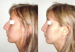Rhinoplastie en Tunisie: chirurgie esthétique pour le nez