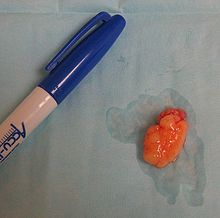 Peut-on appliquer la technique de liposuccion à l’excision des lipomes ?